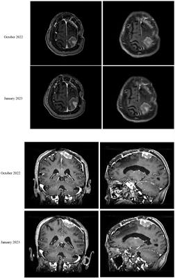 Case Report: Recurrent meningioma with multiple metastases